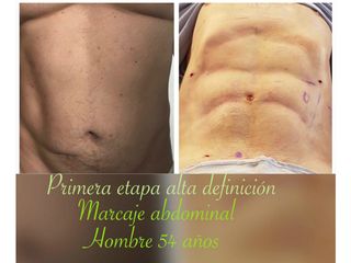 Antes y después Marcaje abdominal