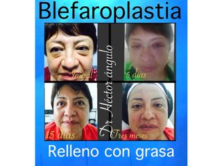 Antes y después Blefaroplastia con grasa