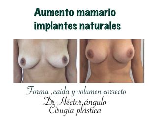 Antes y después Aumento de busto 