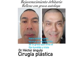 Antes y después Rejuvenecimiento facial