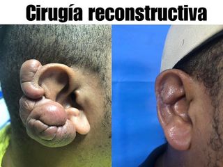 Antes y después Cirugía reconstructiva