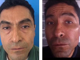 Antes y después Rejuvenecimiento facial 