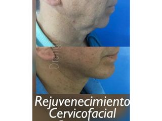 Antes y después Rejuvenecimiento facial