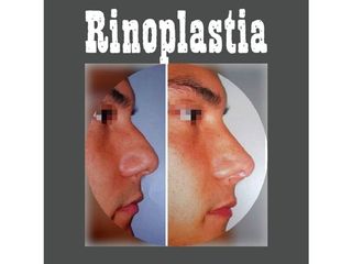 Antes y después Rinoplastia