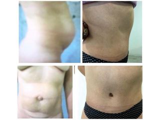 Antes y después Abdominoplastia