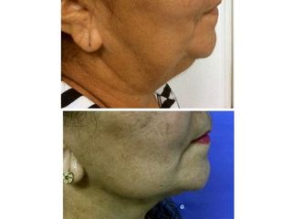 Antes y después Lifting facial