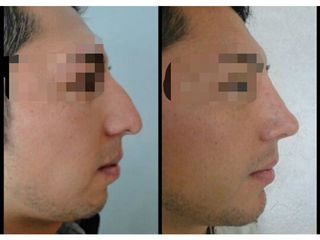 Antes y después Rinoplastia