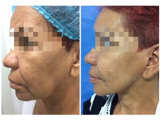 Antes y después Rejuvenecimiento facial