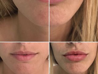 Antes y después de  Aumento de labios con Ácido Hialurónico 