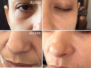 Antes y después de Tratamiento de ojeras y surcos nasogeneanos con Ácido hialurónico 