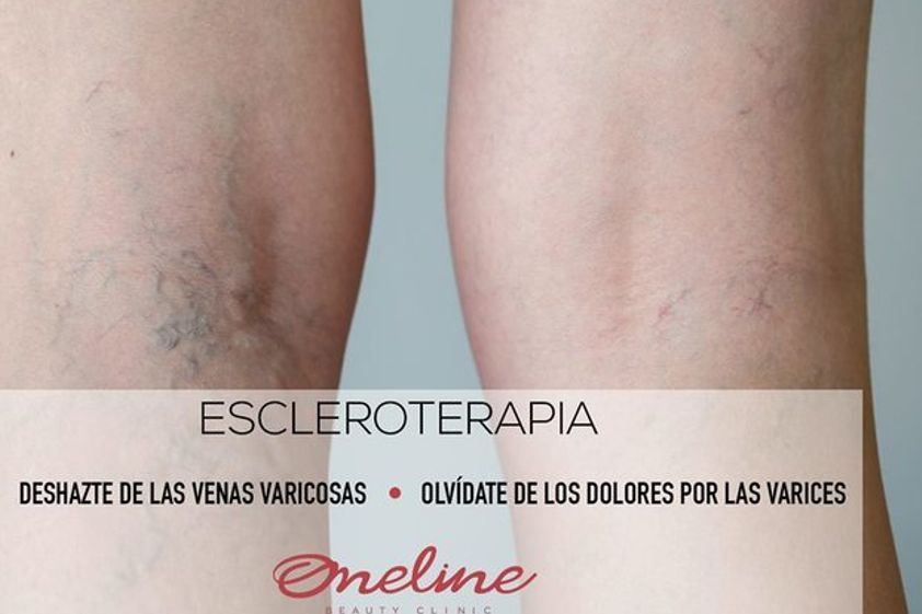Cirugía varices antes y después - 605643