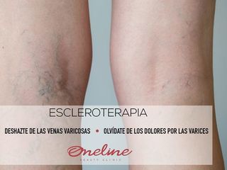 Antes y después de escleroterapia