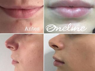 Antes y después de volumen en los labios con Ácido Hialurónico 