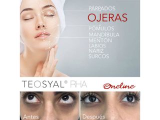 Antes y después de eliminación de ojeras con Ácido hialurónico