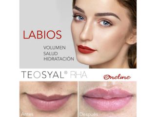 Antes y después de Aumento de labios