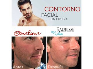 Antes y después de contorno facial con Ácido hialurónico