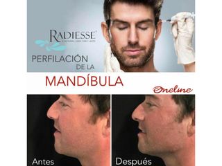 Antes y después de Perfilación de la mandíbula