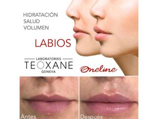 Antes y después de aumento de labios