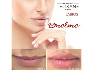 Antes y después de Aumento de labios