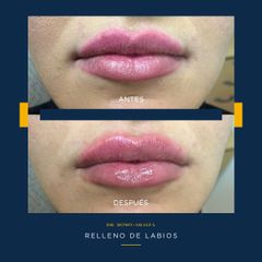 Aumento de labios - Dr. Homero Romo Araiza
