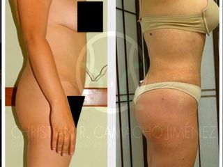 Antes y después de Aumento de glúteos