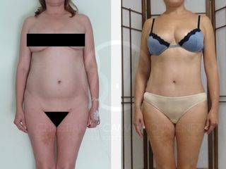 Antes y después de Mommy Makeover