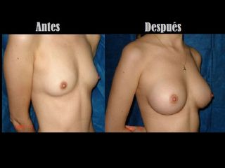 Antes y después de Aumento de busto