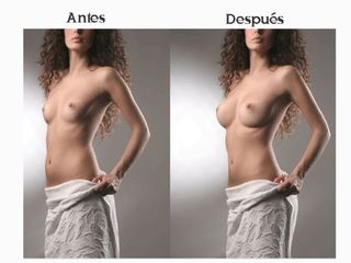 Antes y después de Aumento de busto