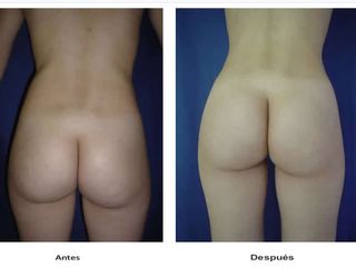 Antes y después de Liposucción