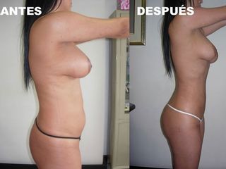 Antes y después de Liposucción