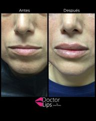 Aumento de labios - Dra. Maritgen Chacón