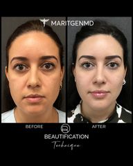 Rejuvenecimiento facial - Dra. Maritgen Chacón