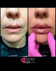 Aumento de labios - Dra. Maritgen Chacón