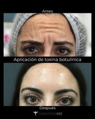 Toxina Botulínica  - Dra. Maritgen Chacón