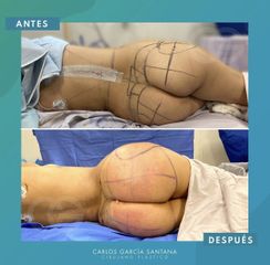 Gluteoplastia - Dr. Carlos Santana 