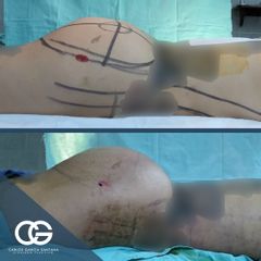 Gluteoplastia - Dr. Carlos Santana 