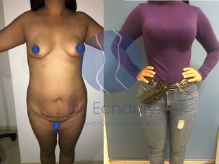 Antes y después de Liposucción