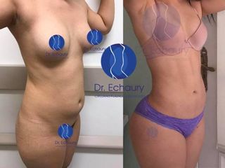Antes y después de lipoescultura HD