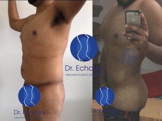 Antes y después de Lipoescultura HD de 360 grados con Brazilian buttlift