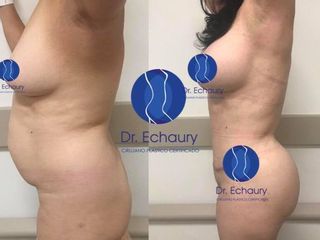 Antes y después de  Mommy Makeover 