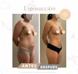 Liposucción - Dra. Margarita María Baquero Umaña