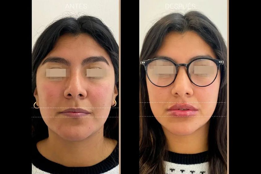 Aumento de labios antes y después - 840075