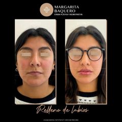 Aumento de labios - Dra. Margarita María Baquero Umaña