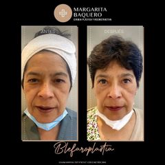 Blefaroplastia - Dra. Margarita María Baquero Umaña