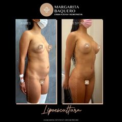 Lipoescultura - Dra. Margarita María Baquero Umaña