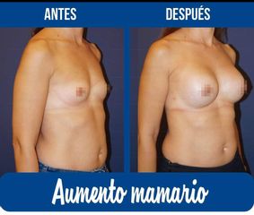 Antes y después de Aumento de busto