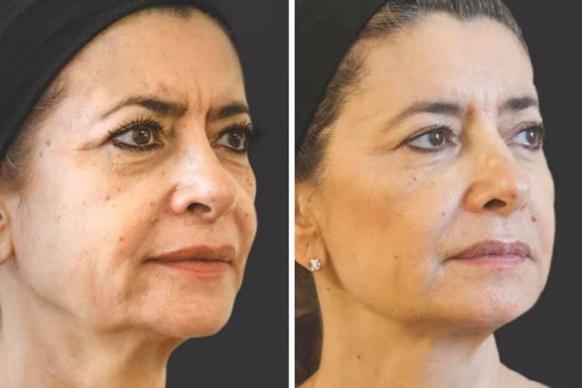 Tratamientos faciales antes y después - 843203