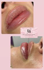 Aumento de labios - Dra. Diana Hannah Carreón