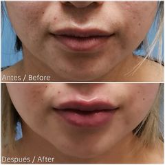 Aumento de labios - Dr. Angel Mendoza