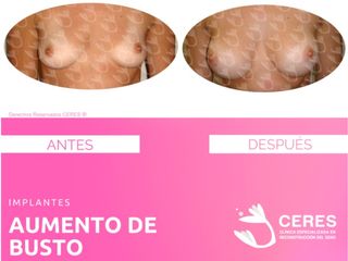 Antes y después de Aumento de Busto